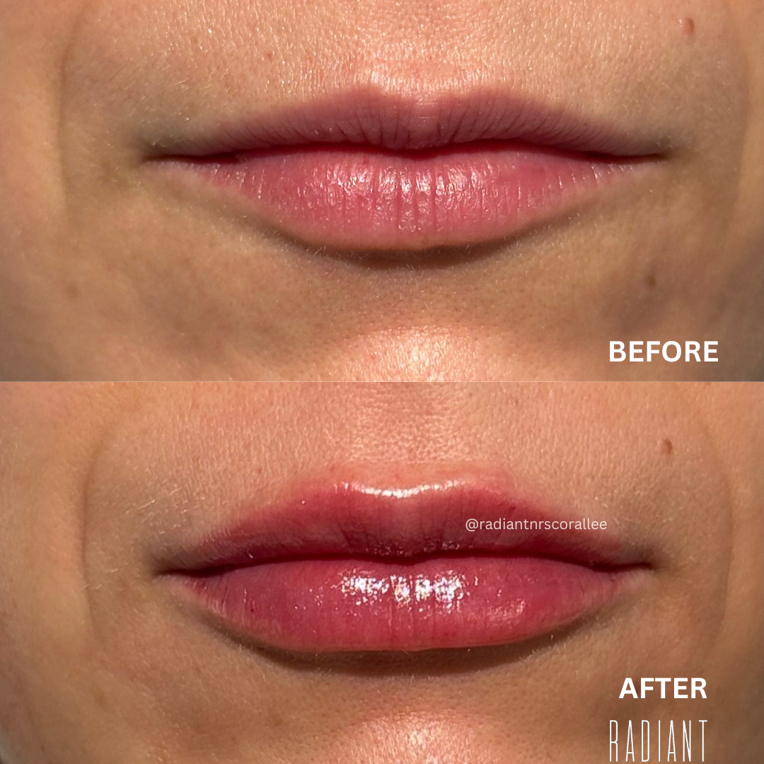 corlips