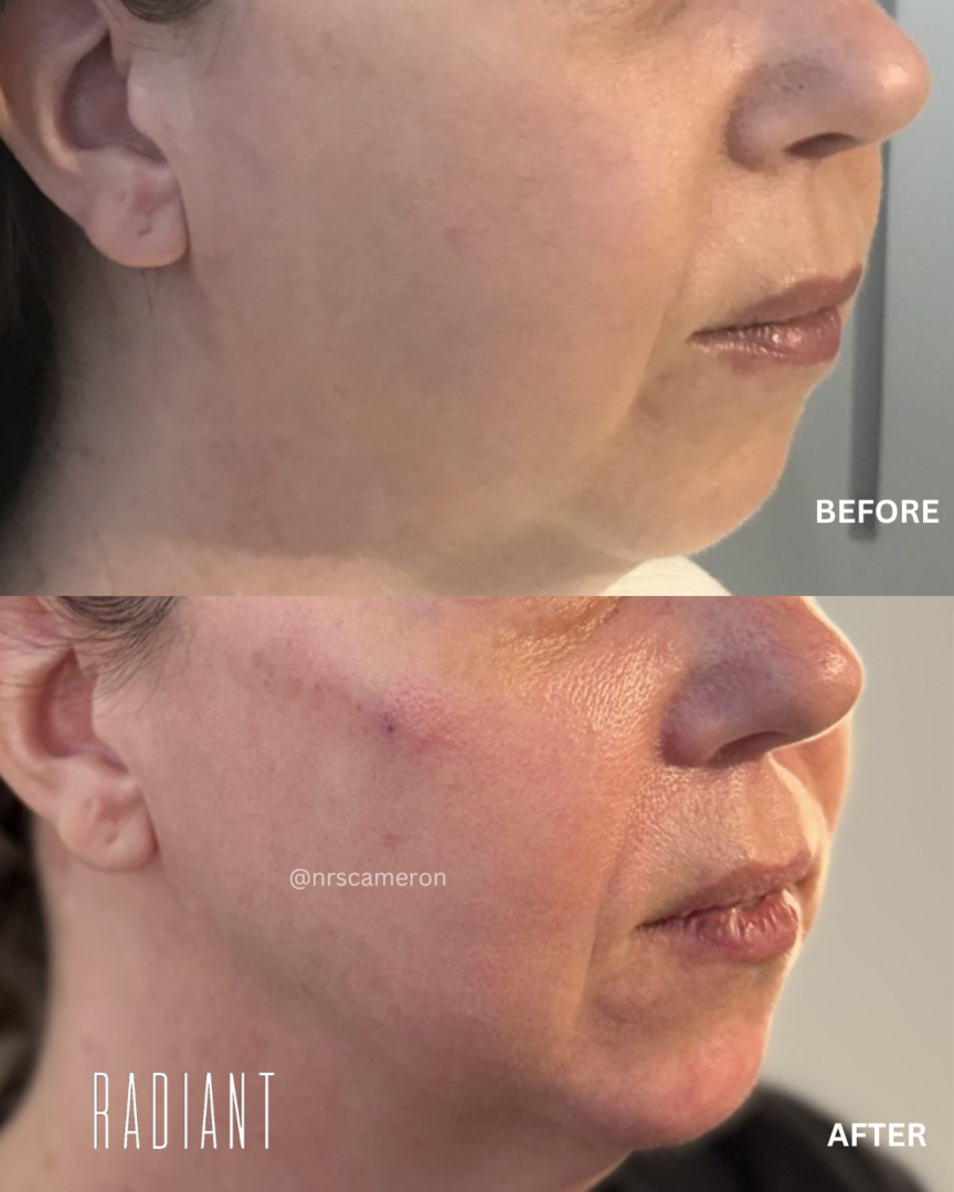 jawlineenh